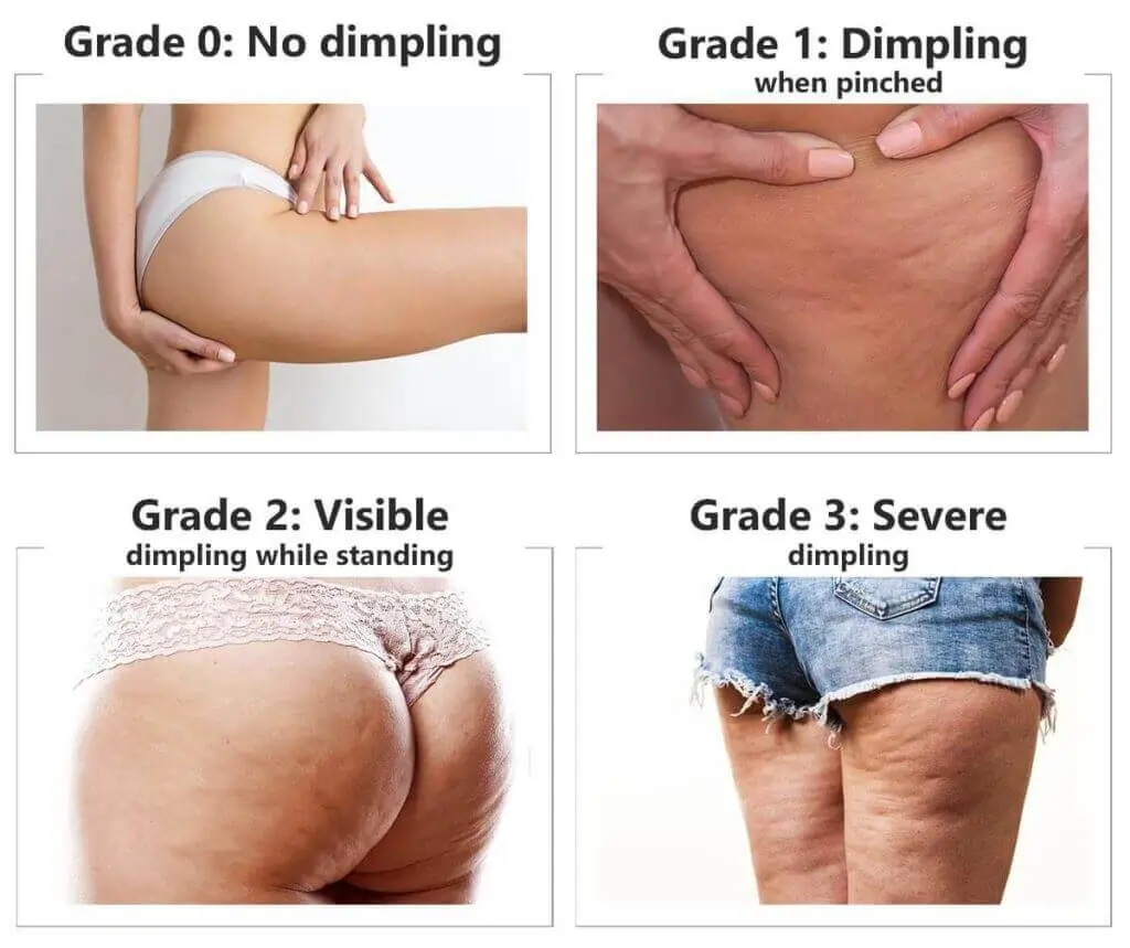 Representation of the stages of cellulite development Shepperton