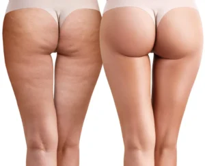 Unveiling the Truth: How Many Grades of Cellulite Are There {name}